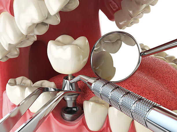 Best Broken or Cracked Tooth Emergency Dentist in Buckhead, GA